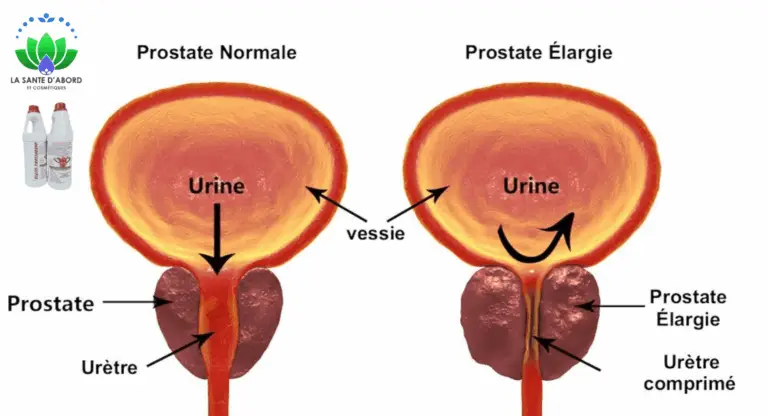 prostate